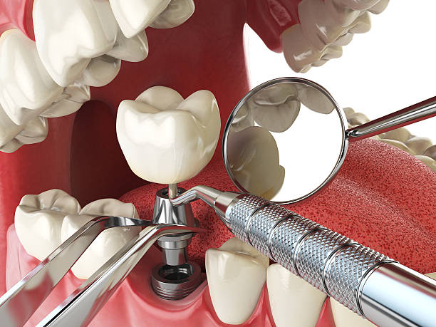 Best Urgent Tooth Repair  in Bunker Hl, IL